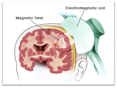 transcranial-magnetic-stimulation-near-me